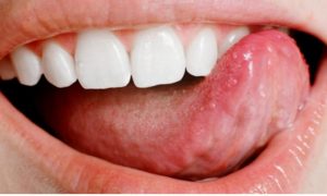 Dildeki yaralara ne iyi gelir ? Nasıl Geçer ? Evde Bitkisel Çözüm