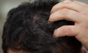 Tedavi Yöntemi ; Saç derisinde egzama nasıl tedavi edilir?
