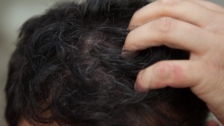  Tedavi Yöntemi ; Saç derisinde egzama nasıl tedavi edilir?