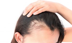 Kadınlarda Saç Dökülmesi Neden Olur, Kadınlara Saç Ekimi Nasıl Yapılır?